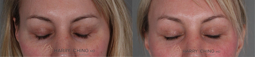 Brow Lift+ Lower Bleph patient 1 pic 1