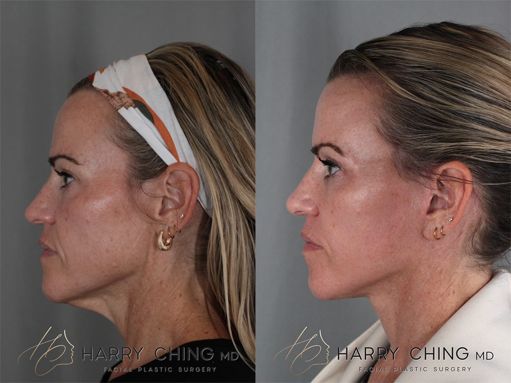 facelift 1-1