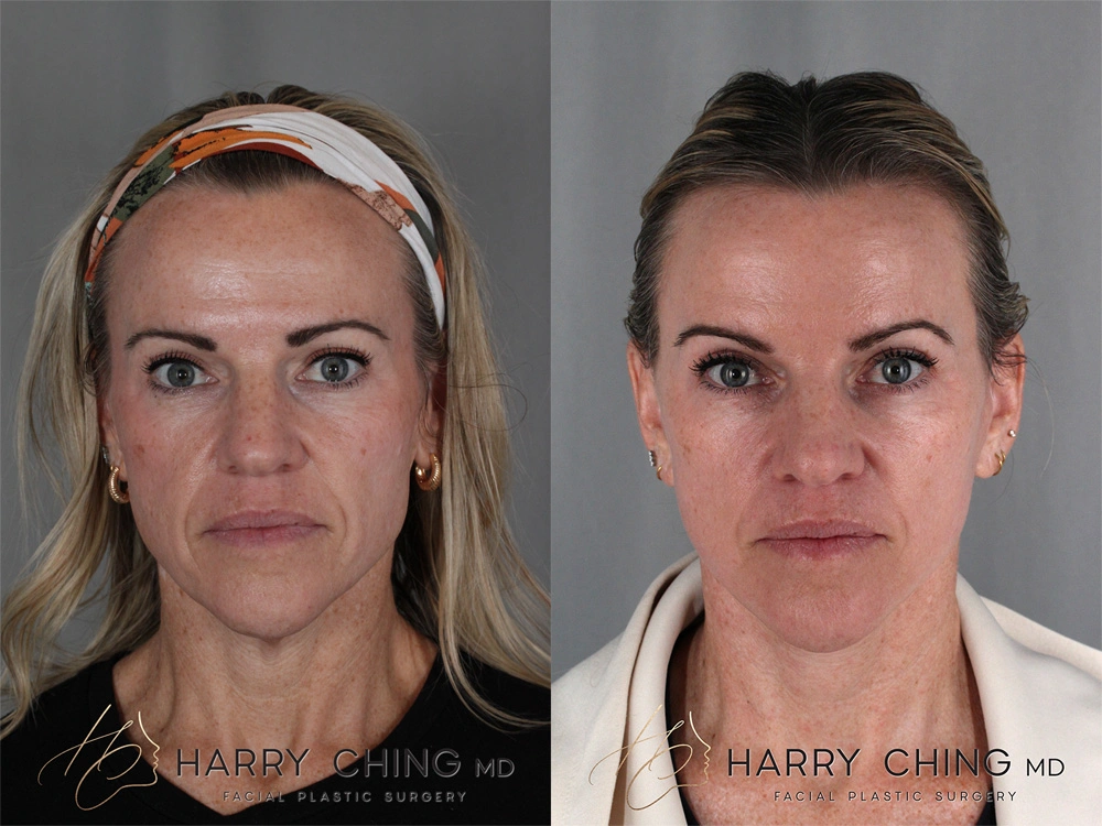facelift 1-2