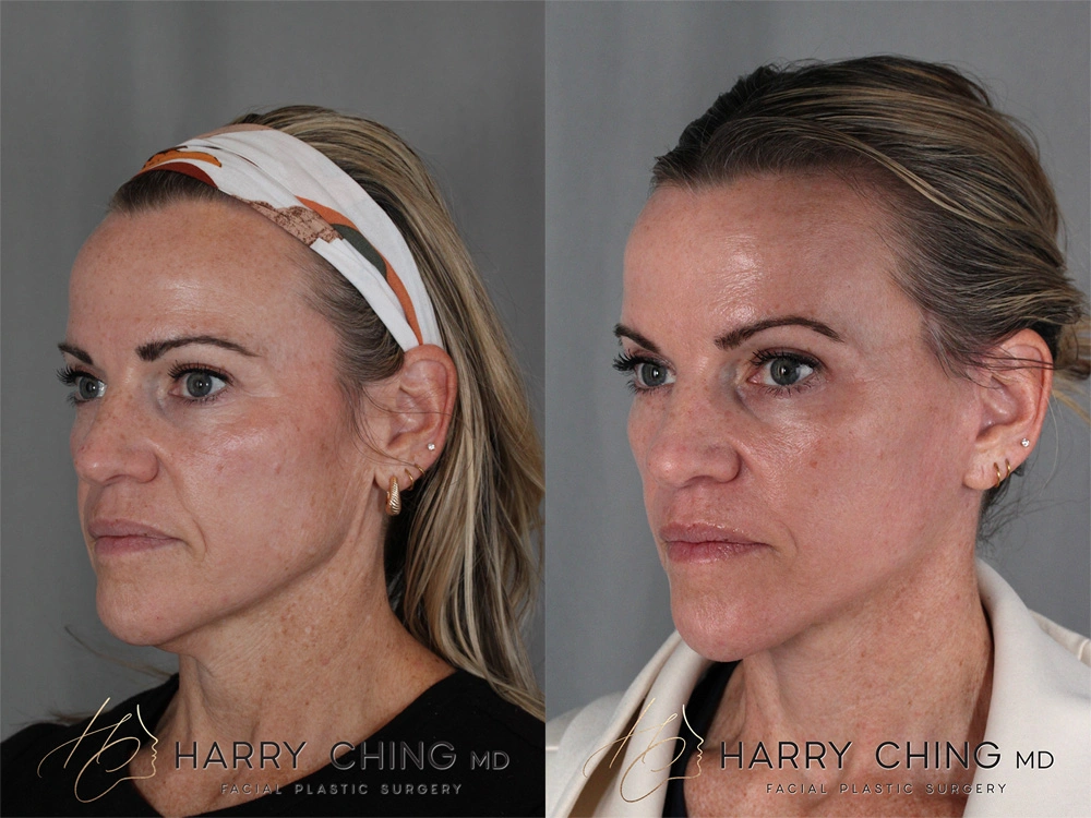 facelift 1-3