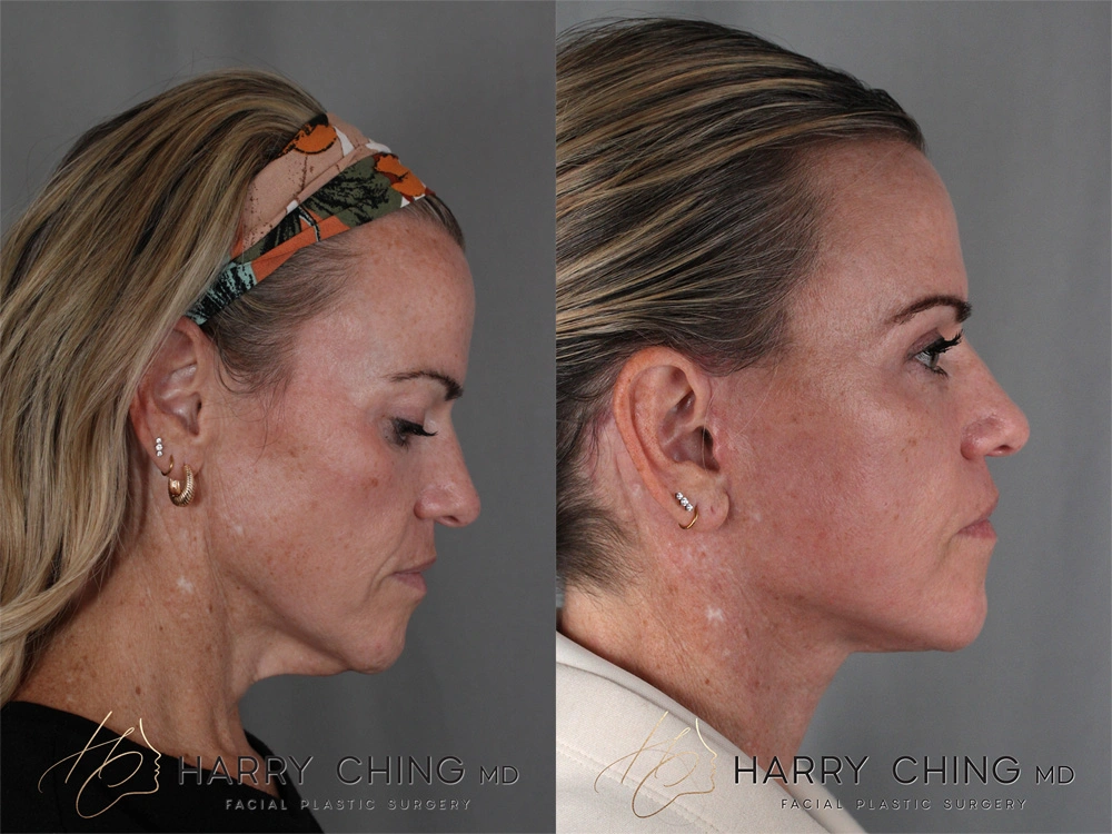 facelift 1-4