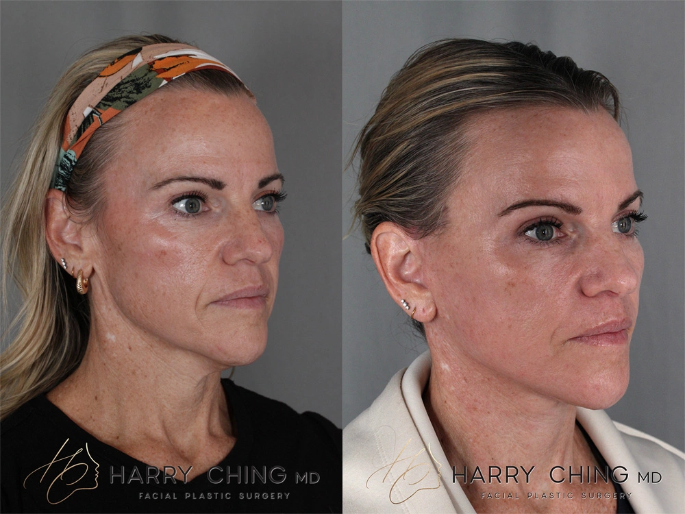 facelift 1-5