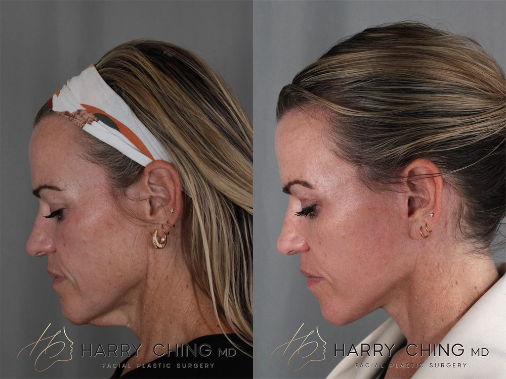 facelift 1-6
