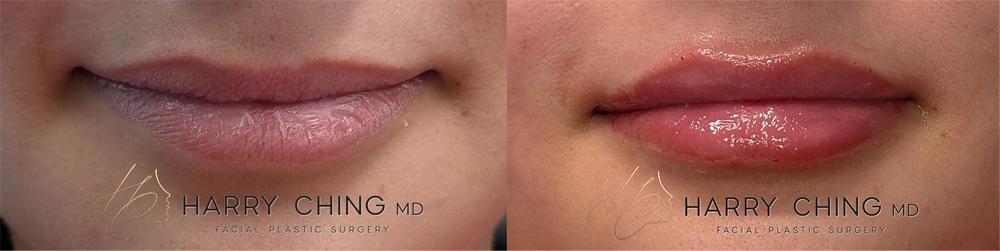 lip filler 1-1