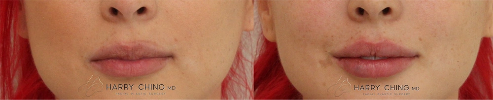 lip filler 2-1