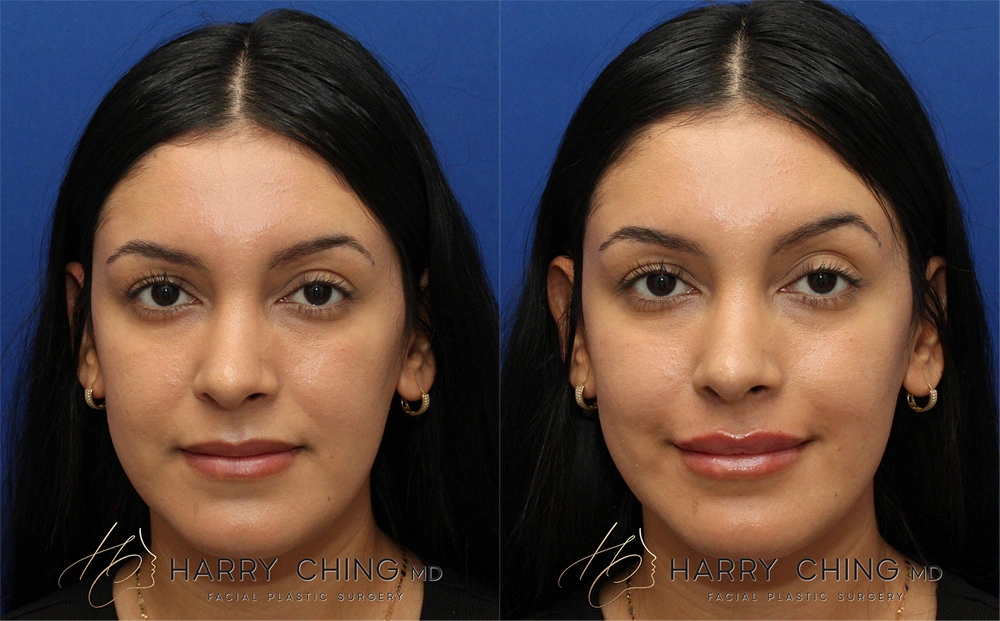 lip filler 3-1