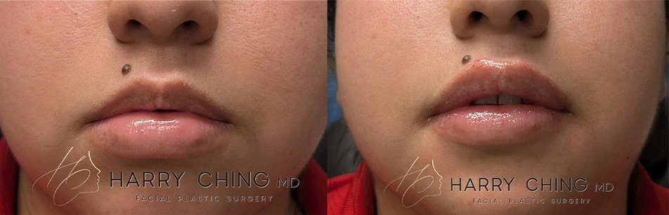 lip filler 4-1