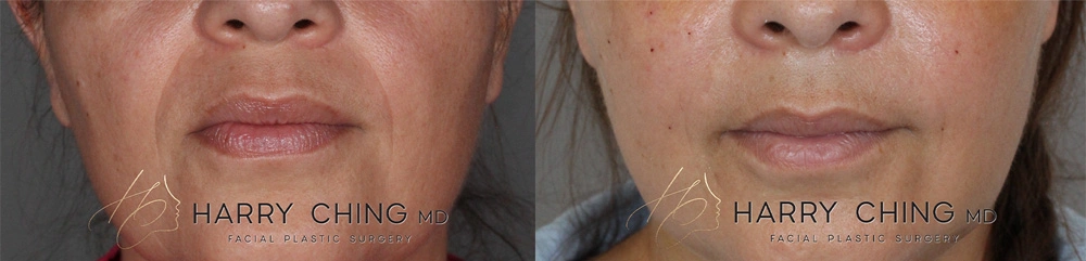 lip filler 5-1