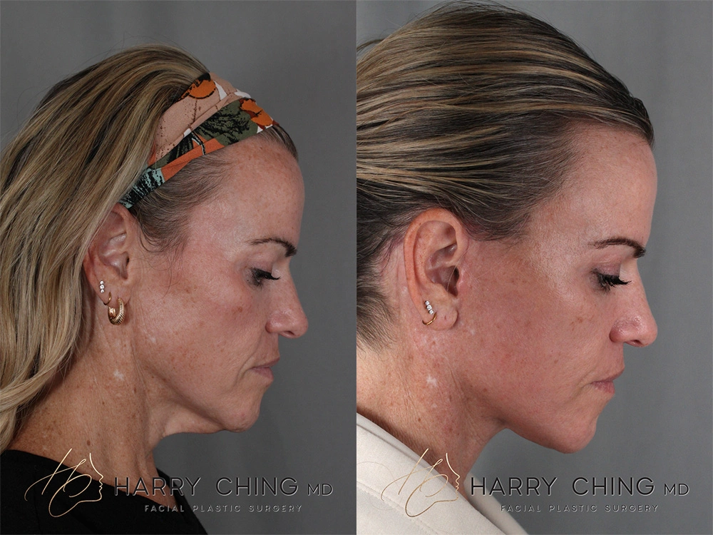 neck 1-2