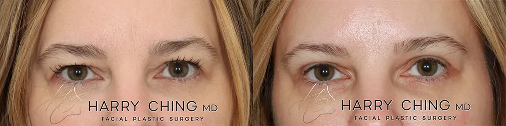 upper eyedlid lift-HC-01