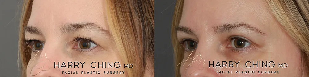upper eyedlid lift-HC-02