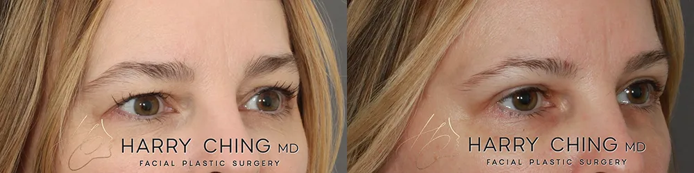 upper eyedlid lift-HC-03